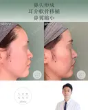 鼻尖形成+耳介軟骨移植+鼻翼縮小 after画像 サムネイル用