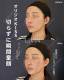 オリジオKISS両頬＋フェイスライン400shot before画像 サムネイル用