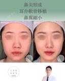 鼻尖形成+耳介軟骨移植+鼻翼縮小 after画像 サムネイル用