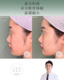 鼻尖形成+耳介軟骨移植+鼻翼縮小 after画像 サムネイル用