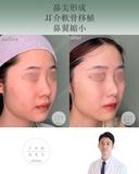 鼻尖形成+耳介軟骨移植+鼻翼縮小 after画像 サムネイル用