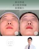 鼻尖形成+耳介軟骨移植+鼻翼縮小 after画像 サムネイル用