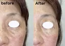目の下ヒアルロン酸注入 after画像 サムネイル用