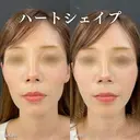 ハートシェイプ after画像 サムネイル用