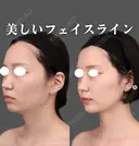 ベイザー頬＋顎下、ジョールファット脂肪吸引 after画像 サムネイル用
