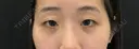 二重埋没 before画像 サムネイル用