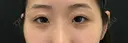二重埋没 after画像 サムネイル用