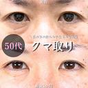 目の下のたるみ取り・クマ取り/脂肪注入(目の下・ゴルゴライン) 90日後 サムネイル用
