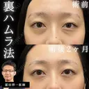目の下のクマ治療🐻『裏ハムラ法』脂肪を移動して若々しい印象へ🌟 after画像 サムネイル用