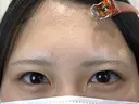 二重埋没　GOLDLONG before画像 サムネイル用