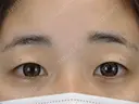 二重埋没　GOLDLONG before画像 サムネイル用