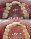 インビザライン before画像 サムネイル用
