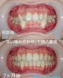 インビザライン before画像 サムネイル用