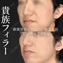 貴族フィラー （鼻翼基部ヒアルロン酸注入術） before画像 サムネイル用
