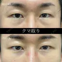 目の下のふくらみ、脂肪取り（クマ取り） after画像 サムネイル用