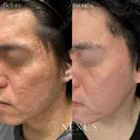 サブシジョン1回＋TCAクロス1回＋ジュベルック（Dr手打ち）1回 after画像 サムネイル用
