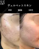 ヴェルベットスキン（ダーマペン4+マッサージピール） after画像 サムネイル用