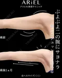 二の腕・肩　脂肪吸引 before画像 サムネイル用
