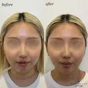 顎ヒアルロン酸　ボトックス before画像 サムネイル用