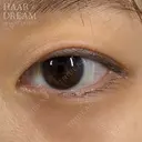 埋没3点留め before画像 サムネイル用