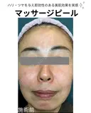 マッサージピール before画像 サムネイル用