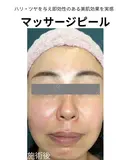 マッサージピール after画像 サムネイル用