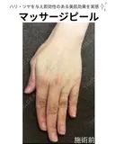 マッサージピール before画像 サムネイル用