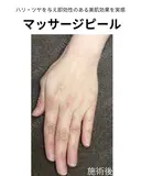 マッサージピール after画像 サムネイル用