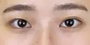 二重埋没法 before画像 サムネイル用
