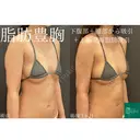 ラグジュアリー💎脂肪豊胸術＋オアシス脂肪吸引（下腹部＋腰）🌴形成外科専門医🥼 before画像 サムネイル用