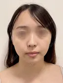 SEAライン ‐３D脂肪吸引（頬・顎） before画像 サムネイル用
