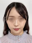 SEAライン ‐３D脂肪吸引（頬・顎） 30日後 サムネイル用