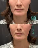 頬ヒアルロン酸 after画像 サムネイル用