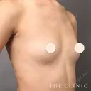 コンデンスビブラ豊胸 before画像 サムネイル用