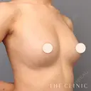 コンデンスビブラ豊胸 after画像 サムネイル用