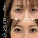 くま取り＋脂肪注入 before画像 サムネイル用