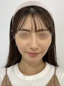 SEAライン ‐３D脂肪吸引（頬・顎）‐・糸リフト 30日後 サムネイル用