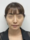 SEAライン ‐３D脂肪吸引（頬・顎）‐・糸リフト before画像 サムネイル用