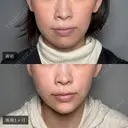 小顔美肌再生（リフトアップ）＋顎（あご）のヒアルロン酸注射＋おでこのしわ治療（ボトックス）＋目尻・目の下のボトックス注射＋ほうれい線のヒアルロン酸注射 before画像 サムネイル用