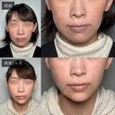 小顔美肌再生（リフトアップ）＋顎（あご）のヒアルロン酸注射＋おでこのしわ治療（ボトックス）＋目尻・目の下のボトックス注射＋ほうれい線のヒアルロン酸注射 30日後 サムネイル用