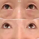 目の下のクマ取り・目の下のたるみ（ふくらみ）取り＋目の下（くぼみ）のヒアルロン酸注射＋シワ取り再生注射（スネコス注射） before画像 サムネイル用