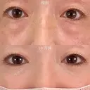 目の下のクマ取り・目の下のたるみ（ふくらみ）取り＋目の下（くぼみ）のヒアルロン酸注射＋シワ取り再生注射（スネコス注射） 30日後 サムネイル用