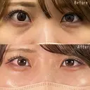 目の下のクマ取り・目の下のたるみ（ふくらみ）取り＋目の下（くぼみ）のヒアルロン酸注射＋クマ取り再生注射 before画像 サムネイル用