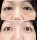目の下のクマ取り・目の下のたるみ（ふくらみ）取り＋目の下（くぼみ）のヒアルロン酸注射 after画像 サムネイル用
