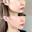 小顔美肌再生（リフトアップ）＋TCB小顔リフト＋顎（あご）のヒアルロン酸注射 before画像 サムネイル用