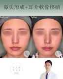 鼻尖形成+耳介軟骨移植 before画像 サムネイル用