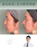 鼻尖形成+耳介軟骨移植 after画像 サムネイル用