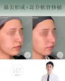 鼻尖形成+耳介軟骨移植 after画像 サムネイル用
