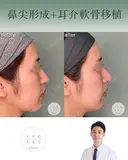 鼻尖形成+耳介軟骨移植 after画像 サムネイル用