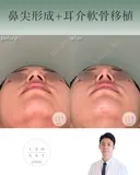 鼻尖形成+耳介軟骨移植 after画像 サムネイル用